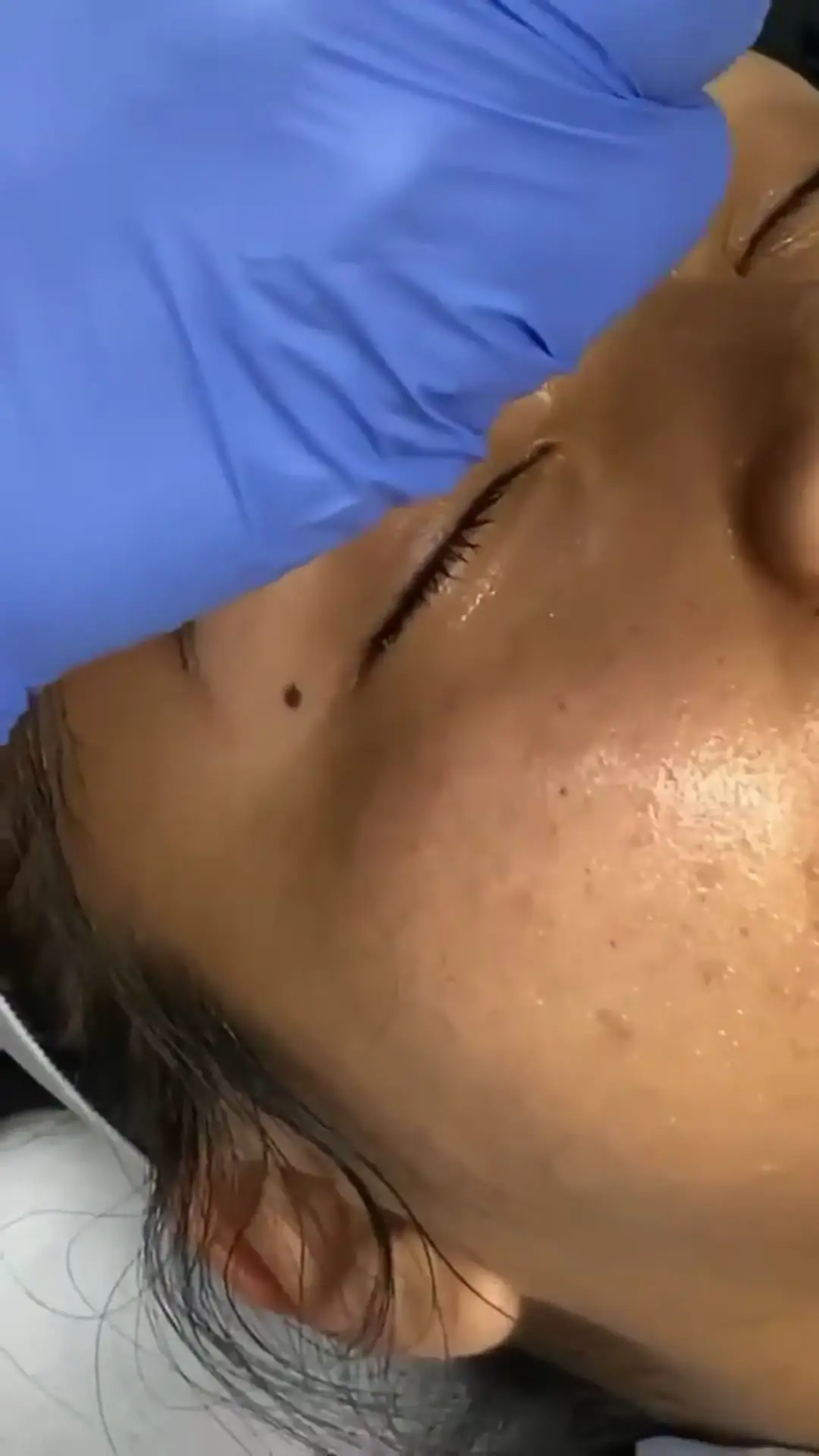 Microneedling du visage en cours : la peau lissée de sérum, la main gantée de l'esthéticienne — SHAY Esthétique, Ahuntsic Montréal
