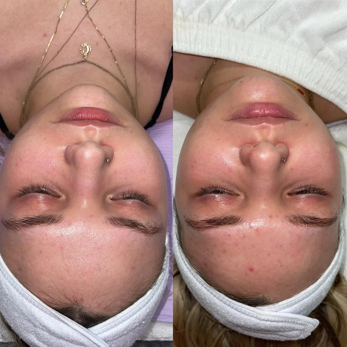 Avant et après : visage — Microneedling