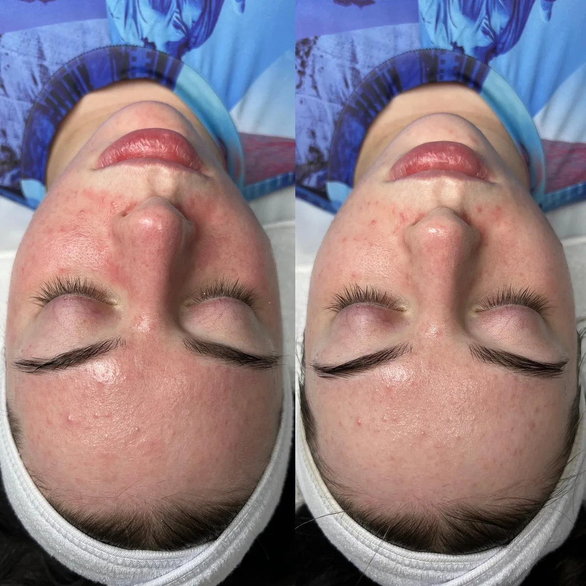 Avant et après : visage — Soin rosacée — avant et immédiatement après