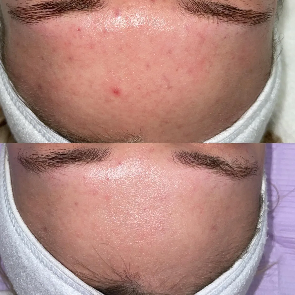 Avant et après : front — Microneedling
