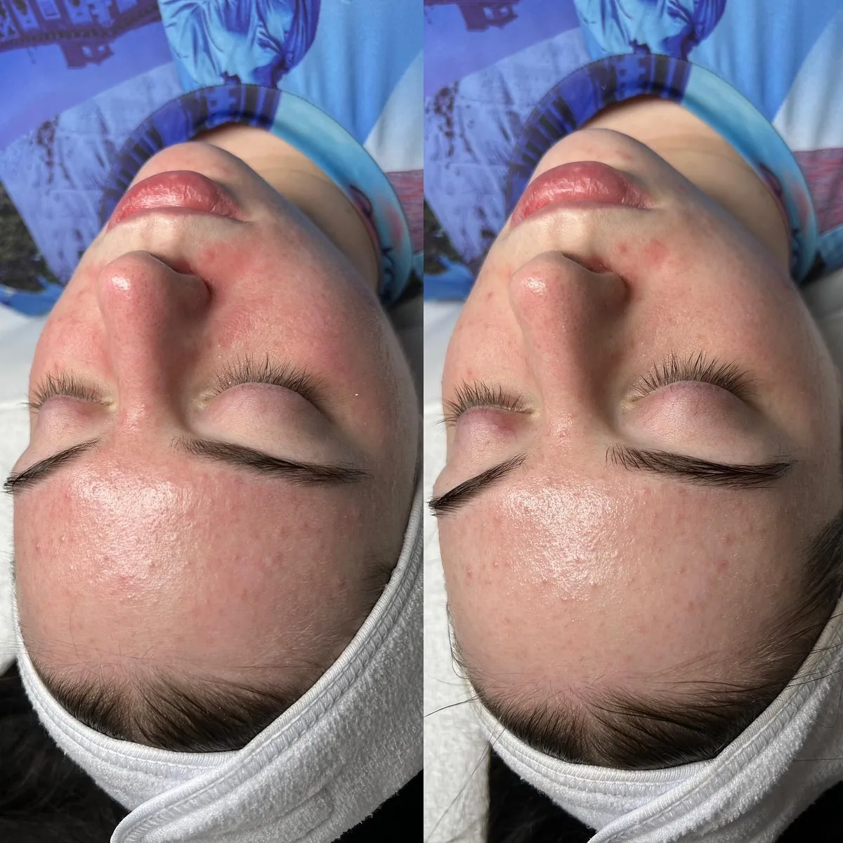 Avant et après : visage, de profil — Soin rosacée — avant et immédiatement après