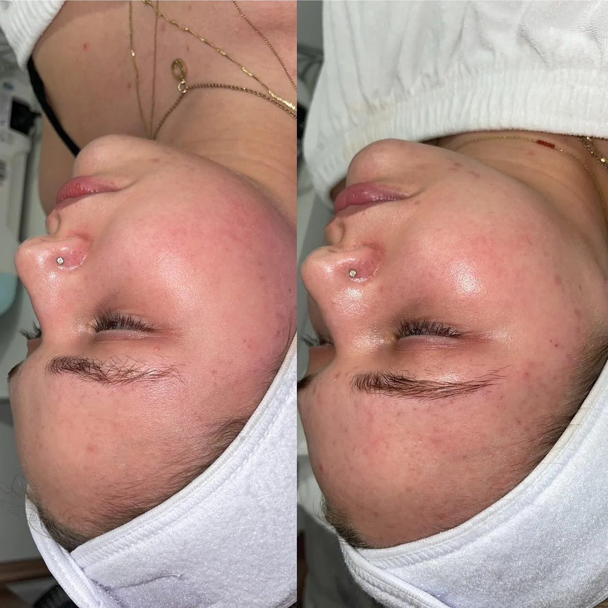 Avant et après : joue — Microneedling
