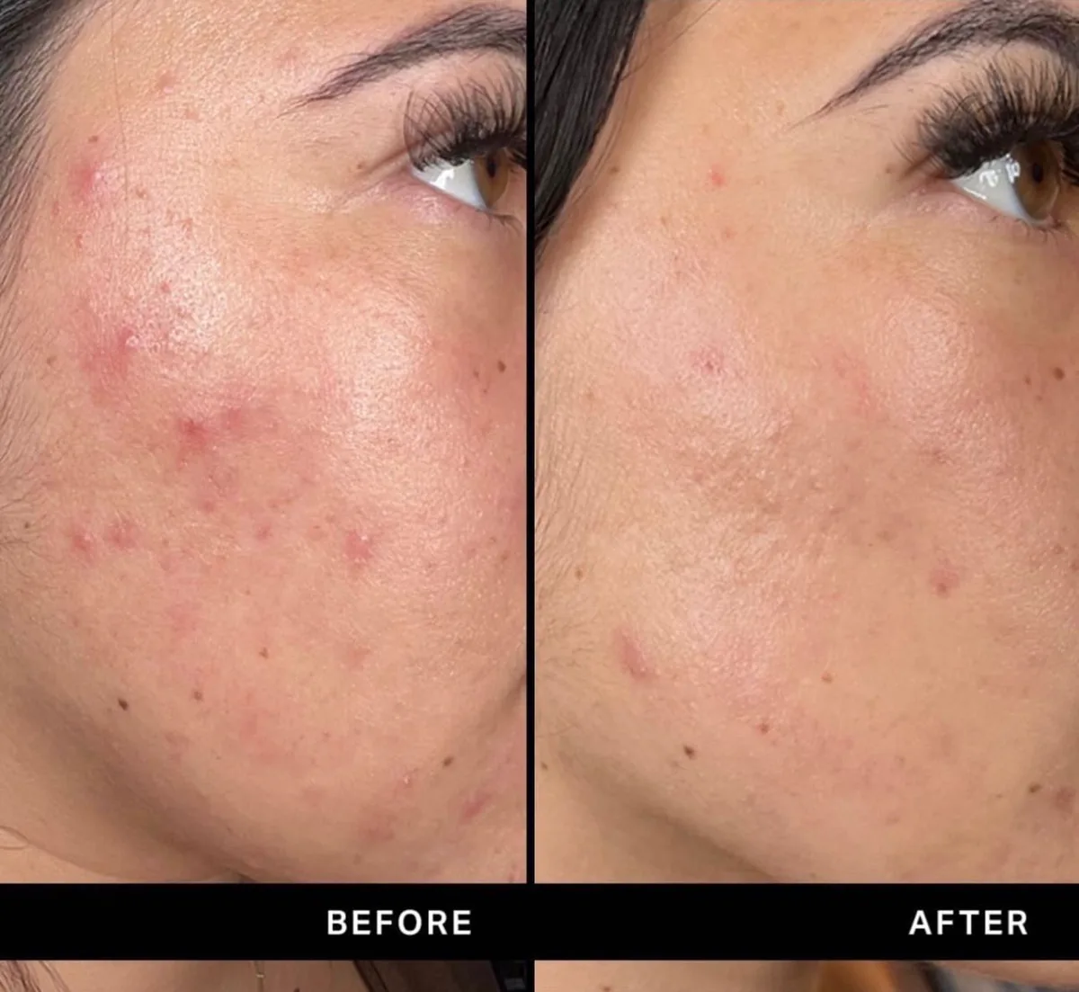 Avant et après : joue — Hydrafacial