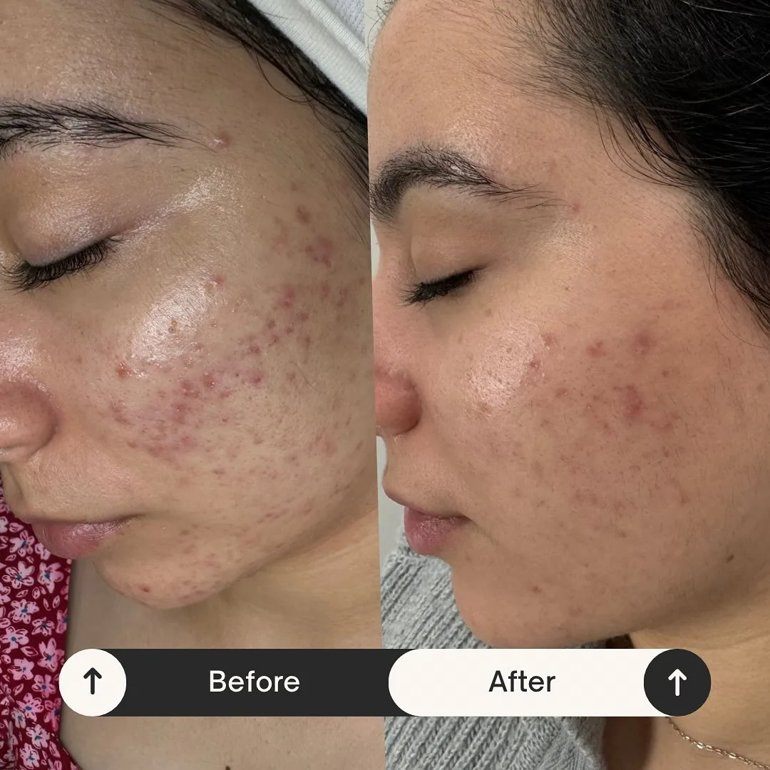 Avant et après : joue — Cure de peeling chimique (3 à 6 séances), routine de soins régulière