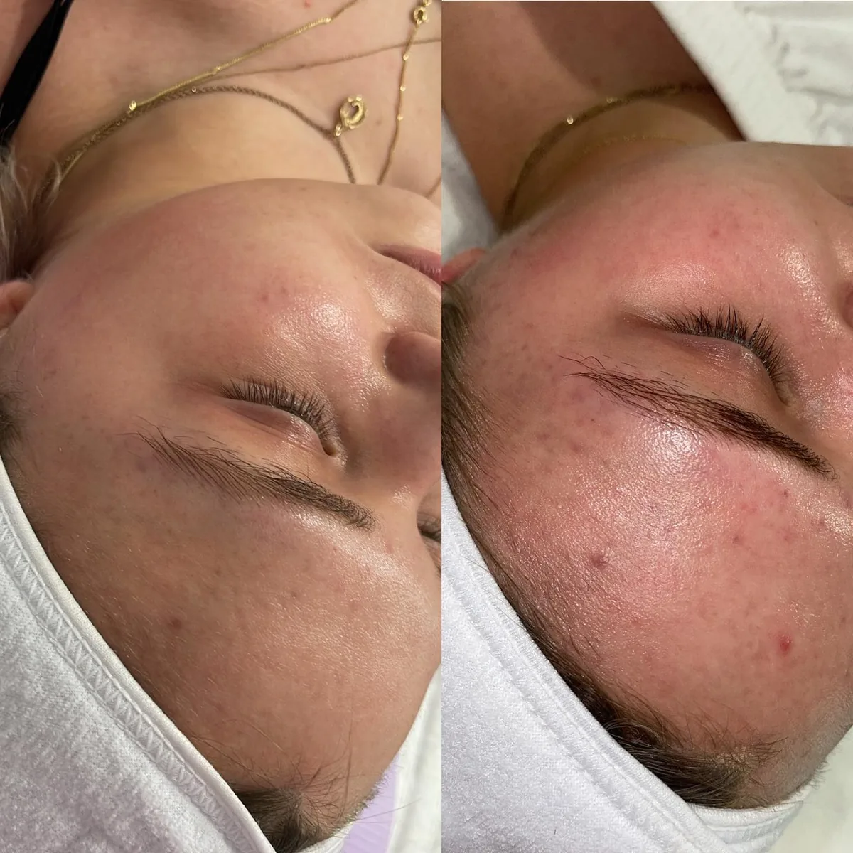Avant et après : tempe — Microneedling