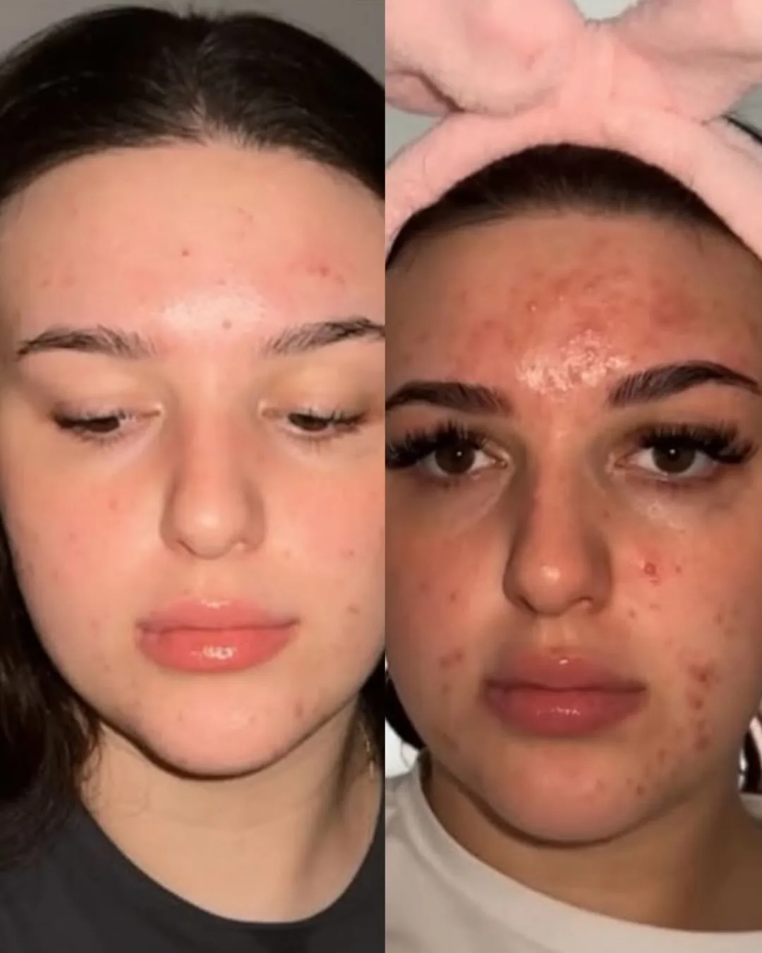 Avant et après : visage — Peeling chimique + Hydrafacial