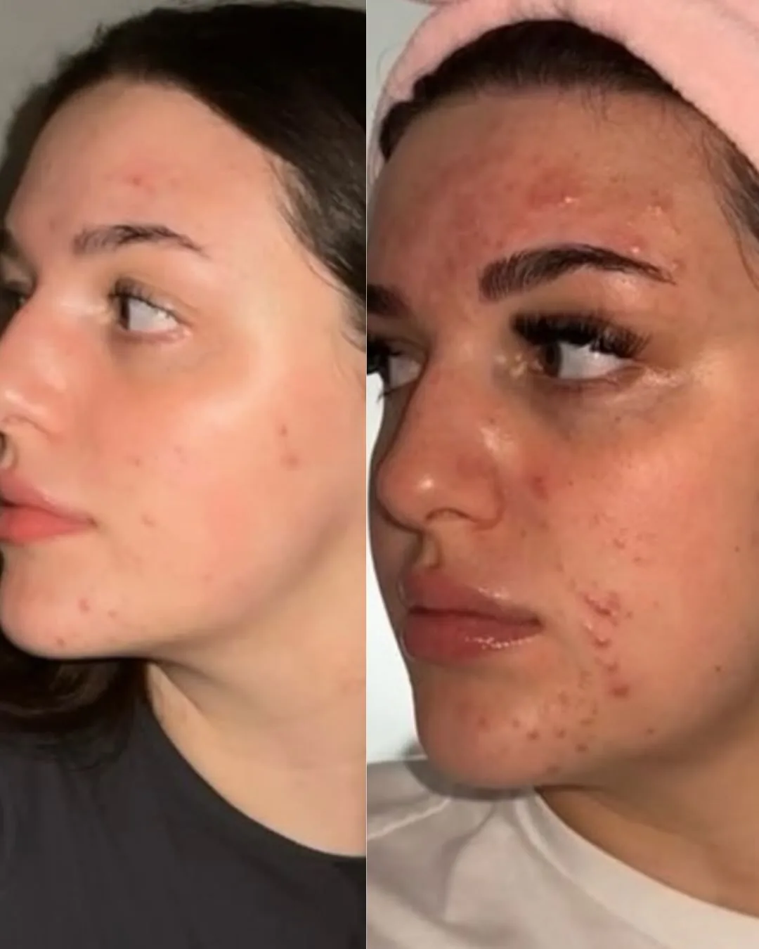 Avant et après : visage, de profil — Peeling chimique + Hydrafacial