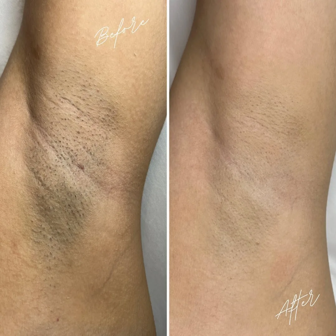 Avant / après épilation laser des aisselles