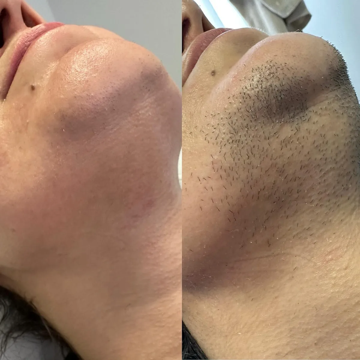 Avant et après : menton et cou — Pilosité d'origine hormonale