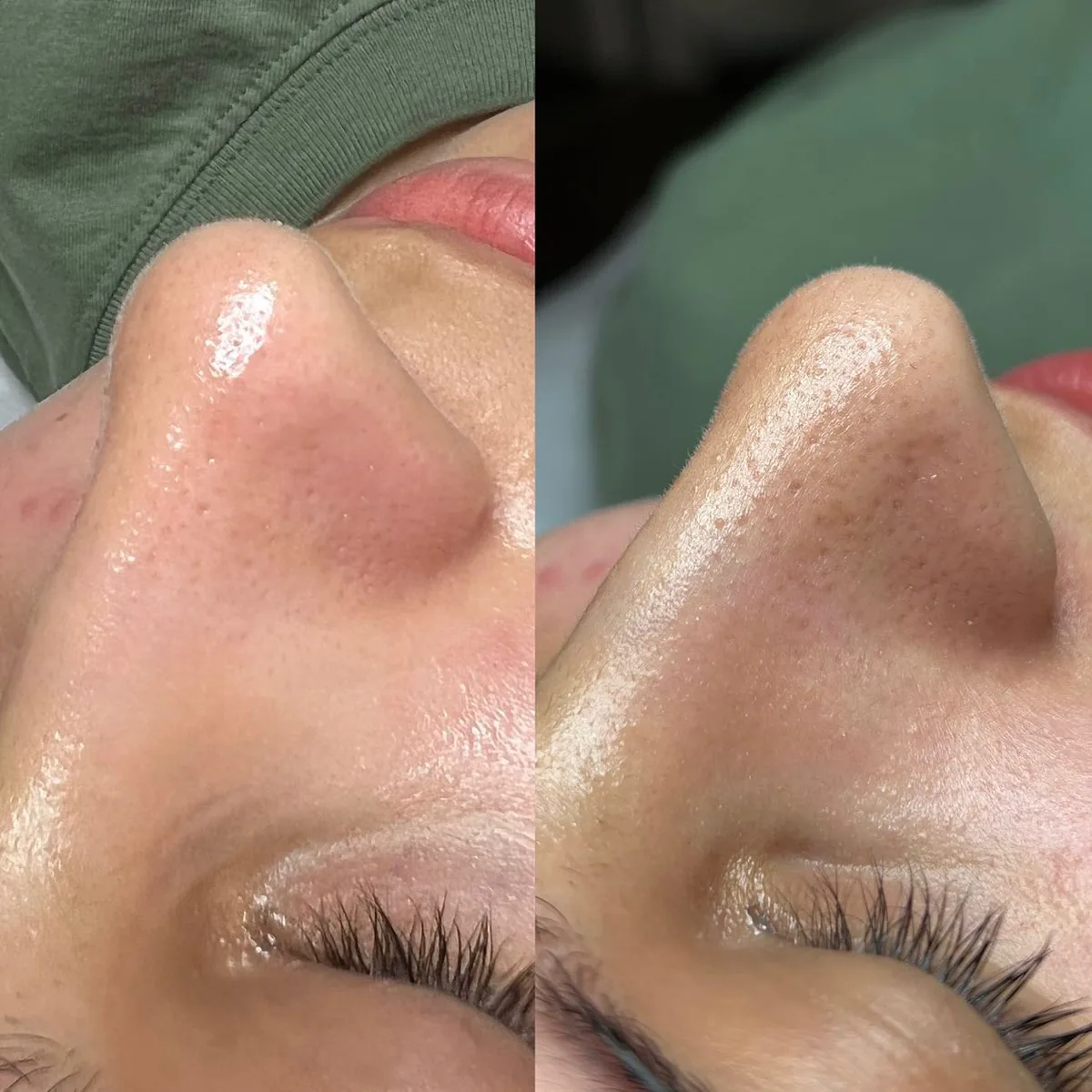 Avant et après : nez — Hydrafacial