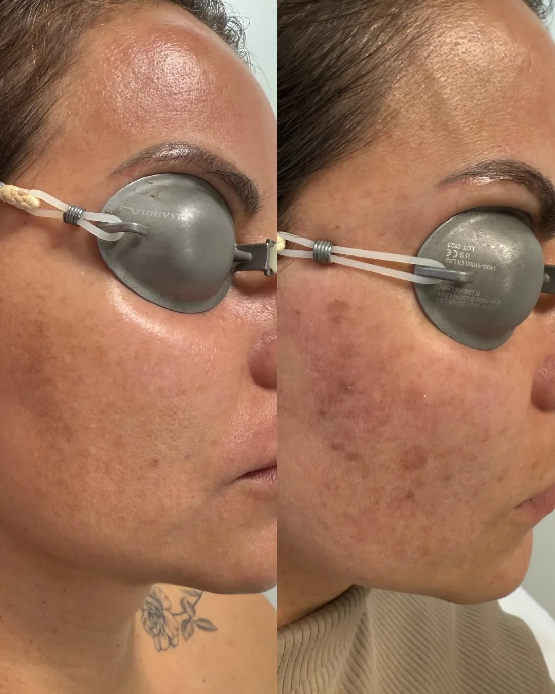 Avant et après : visage — Taches pigmentaires, laser Elite iQ — une seule séance