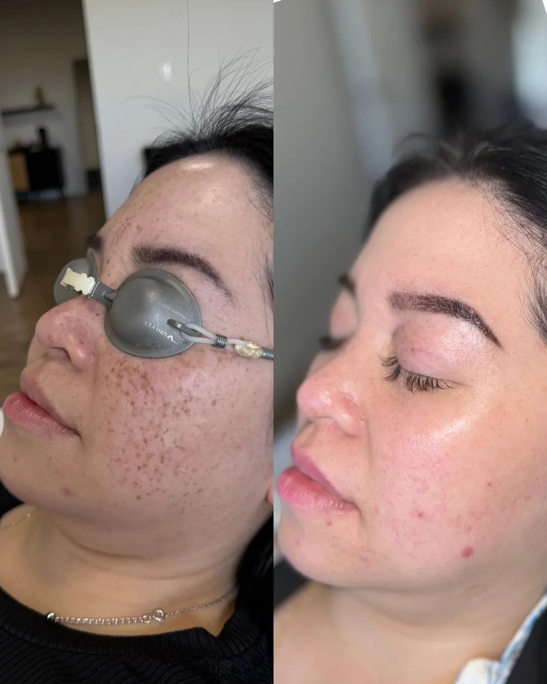 Avant et après : visage, de profil — Taches pigmentaires, laser Cynosure Elite iQ