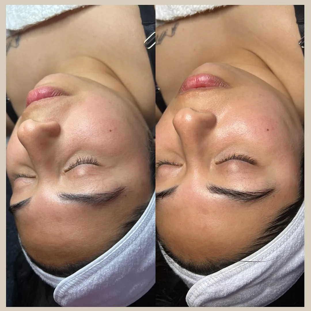 Avant et après : visage — Hydrodermabrasion