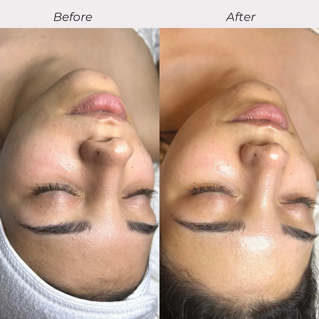 Avant et après : visage — Hydrafacial personnalisé