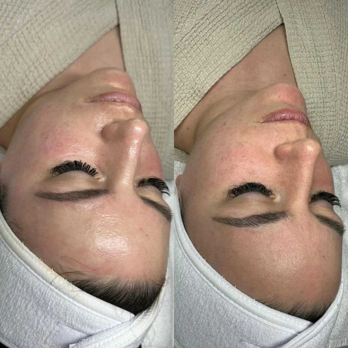 Avant et après : visage — Hydrafacial