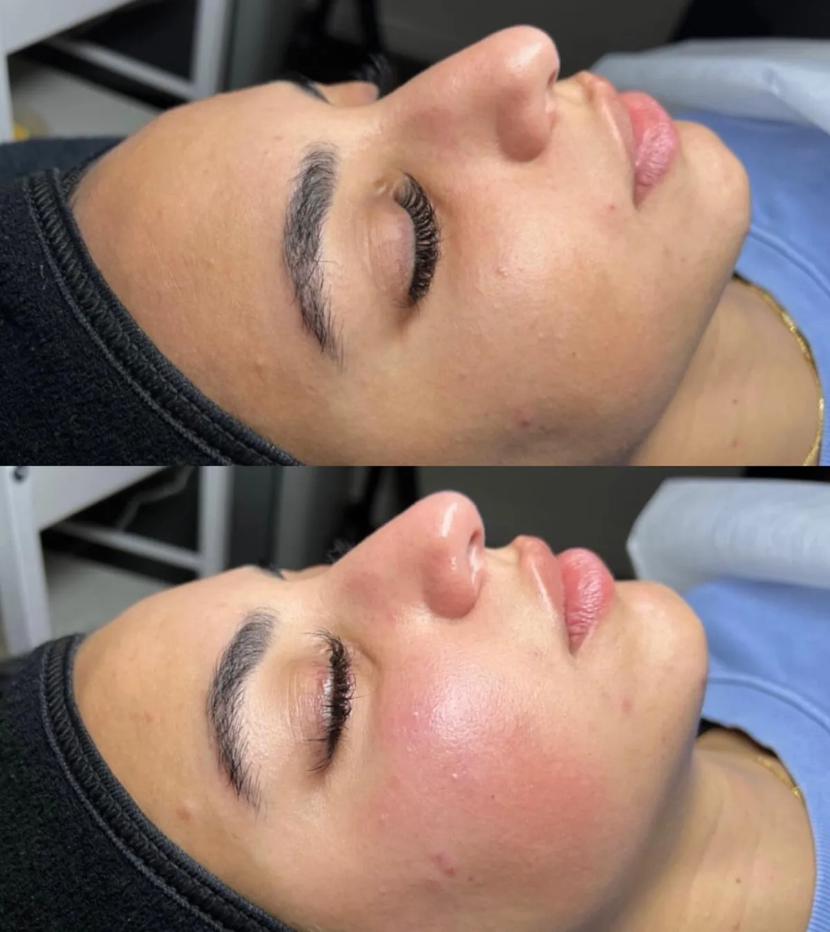 Avant et après : visage — Dermaplaning + Hydrafacial sur mesure