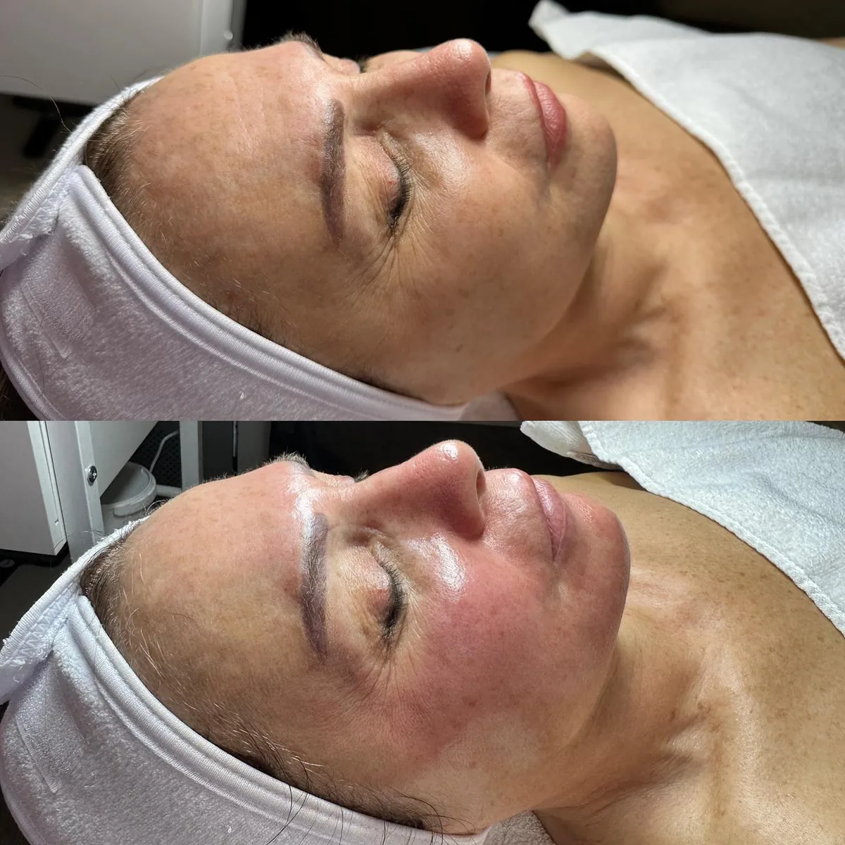 Avant et après : visage — Hydrafacial Platinum, anti-âge