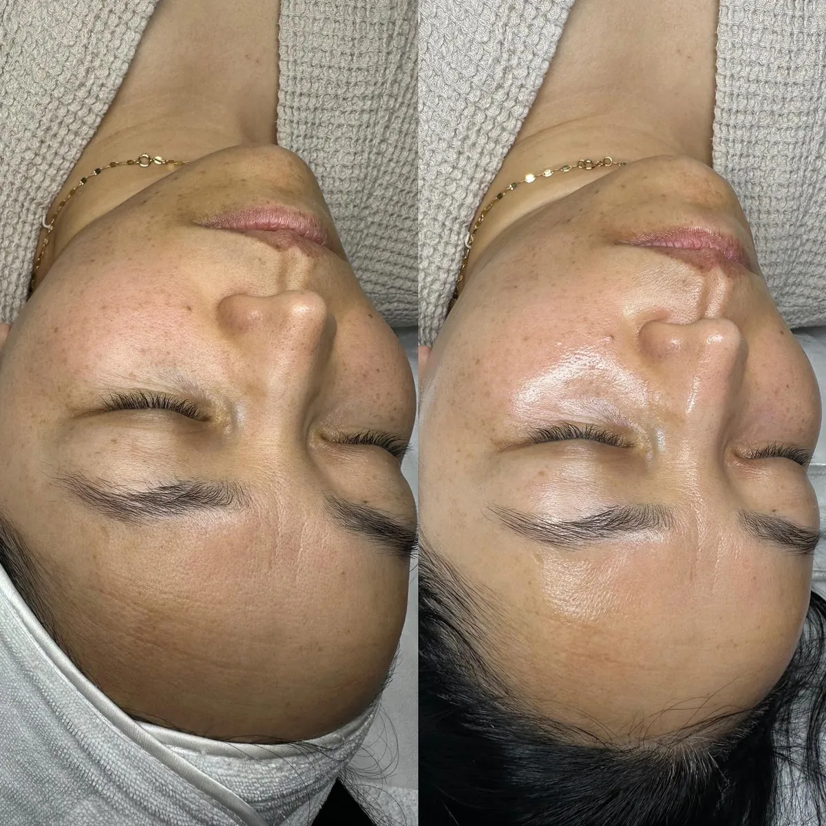 Avant et après : visage — Dermaplaning + Hydrafacial Platinum