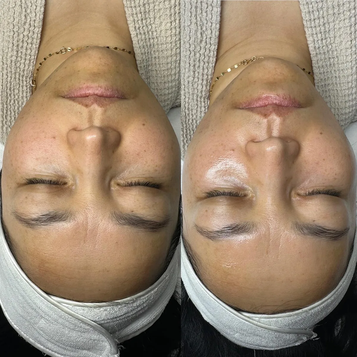 Avant et après : visage — Dermaplaning + Hydrafacial Platinum