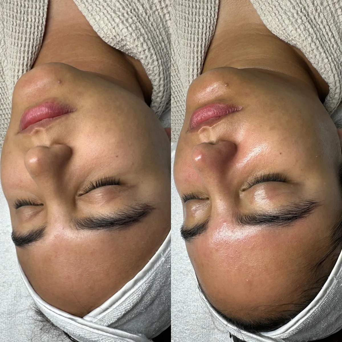 Avant et après : visage — Hydrafacial