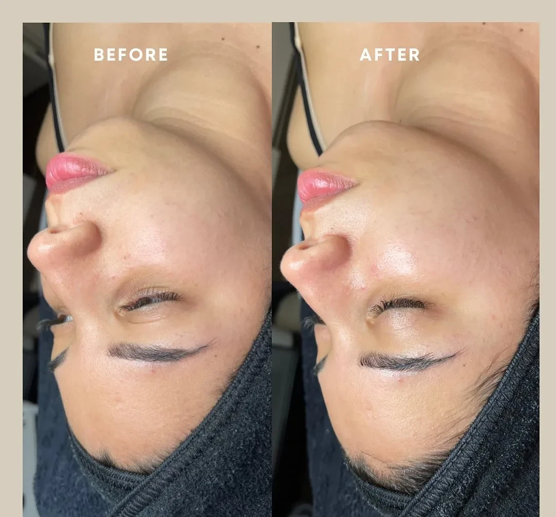 Avant et après : visage — Dermaplaning