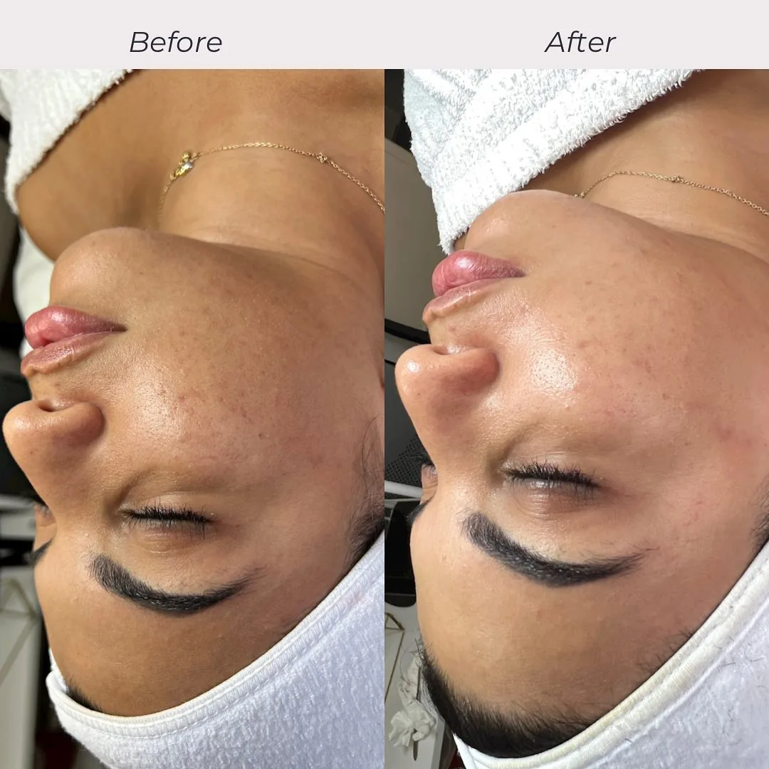 Avant et après : visage — Hydrafacial avec dermaplaning et LED rouge