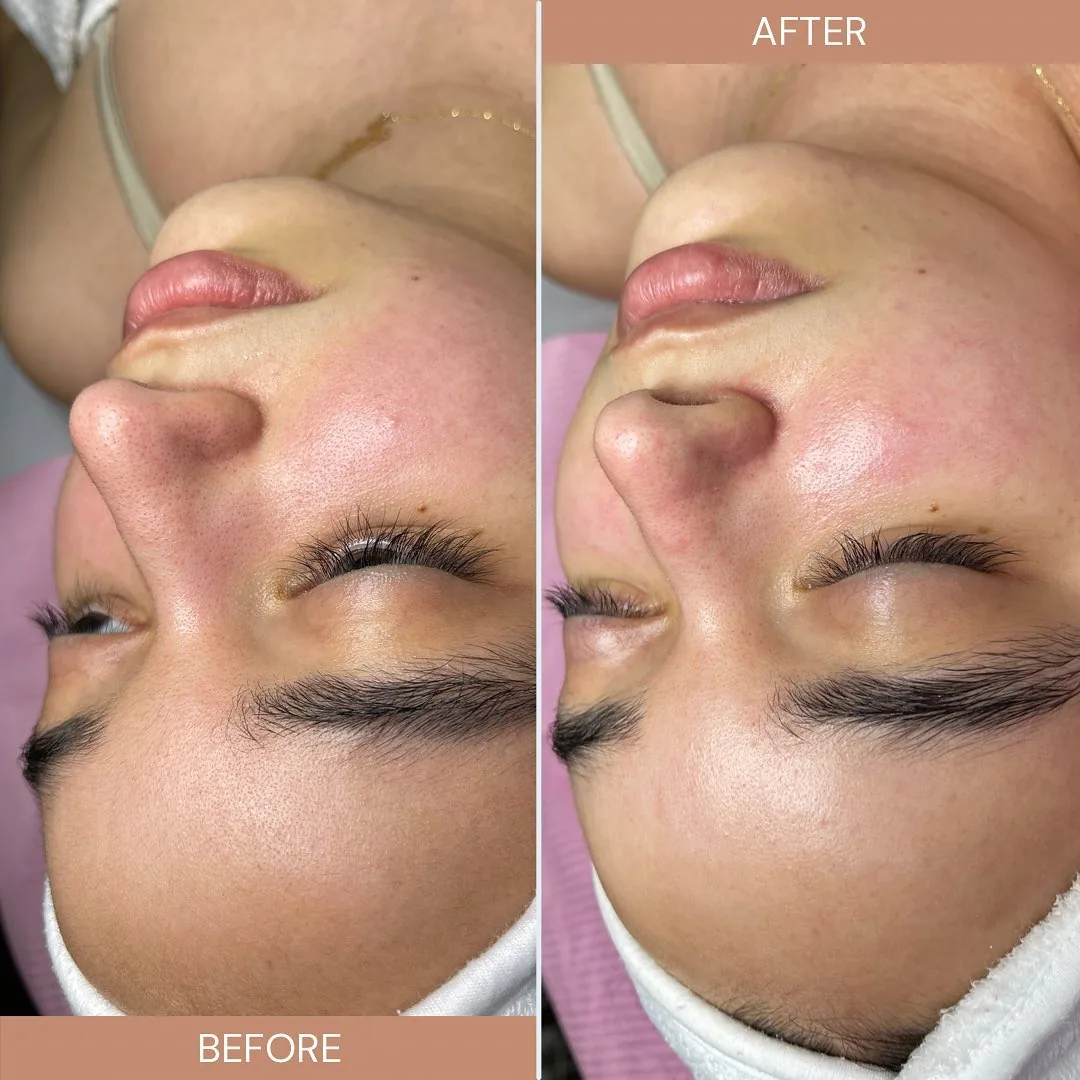 Avant et après : visage — Soin Signature Glow — résultat immédiat