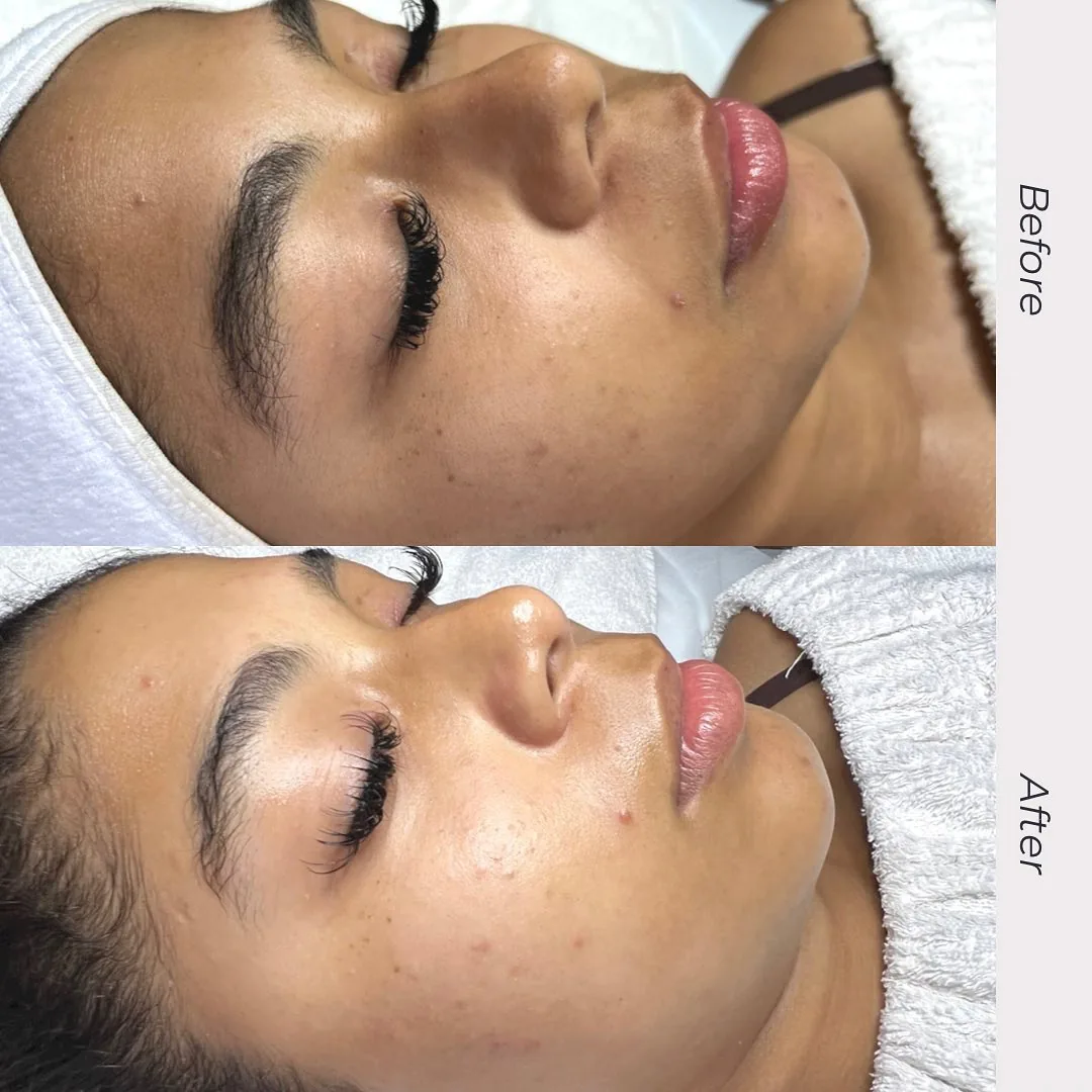 Avant et après : visage — Hydrafacial personnalisé